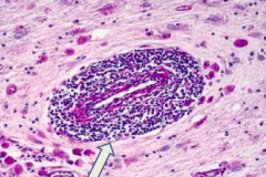 What is the arrow pointing at? Pathology?