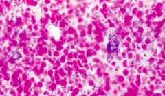 PAS positive macrophages: sign of Adrenoleukodystrophy (Schilder's Disease)