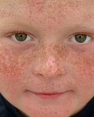 1.  Freckles
