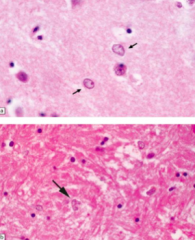 - Alzheimer Type II Astrocytes
- Sign of Hepatic Encephalopathy