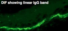 1.  DIF of lesion bx shows IgG and complement in linear band at dermal-epidermal junction