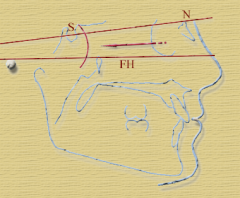 Angle formed between frankfurt horizontal plane and Sella-Nasion Plane. (7 +/- 3 degrees)
