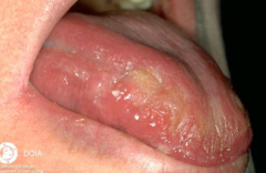 1.  Xerophthalmia
2.  Xerostomia with poor oral health
3.  Xeroderma
4.  Parotid swelling