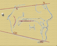 Angle formed betwee the Sella-Nasion plane and the Mandibular plane (32 +/- 5 degrees) 

(Go=Gonion, Me=Menton)