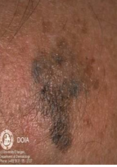 1.  Irregular-shaped tan or brown macule
2.  Enlarges to bizarre coloration, size, and shape
3.  Noninvasive