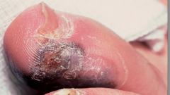1.  Brown or black macules on glabrous skin
2.  MC on soles of foot/palm