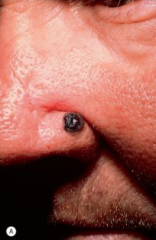 1.  Brown or black papules that slowly and frequently ulcerates
2.  Occurs denovo
3.  More aggressive
