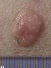 1.  Nonpigmented variant
2.  Can be confused with benign or less aggressive malignant tumors