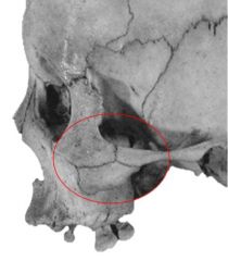 *bipartite (2) or tripartite (3) zygomatic bone
Greater frequency in:
Japanese - 7%
Korean