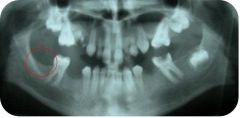 Loss of 3rd molar - failure of tooth development
Commonly influenced by genetics
Little or no selection for trait - good enough for non-metric identifier