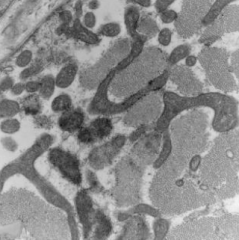 Abnormal - Mitochondrial Myopathy