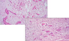 Leigh's Disease
- Spongiform appearance and vascular proliferation