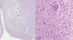 - Pallor
- Myelin loss
- Prominent vessels
- Macrophages
- Relative preservation of neurons