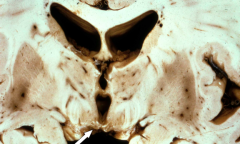 Wernicke Encephalopathy
- Lesions are in mammillary bodies, dorsomedial thalamus, and around 3rd/4th ventricles
- Acutely: gray-brown discoloration with petechial hemorrhages
- Chronically: atrophy and discoloration of mammillary bodies