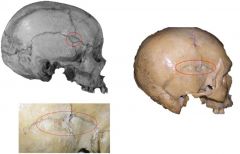 Specific type of Wormian bone
Junction of parietal, frontal, greater wing of sphenoid, squamous portion of temporal bone
Does not indicate ethnicity or race
Some genetic heritability