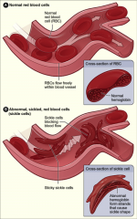 -Normal red cells on top-Sickled cells on the bottomSickled cells do not live as long - spleen removes them, it's job is to remove deformed cells
Can cause clogging of arteries/veins