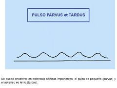 Ictus propulsivo e sustentado de pequena extensão, in situ ou desviado para baixo, pulso tardus e parvus ( ascenção lenta e amplitude fraca).