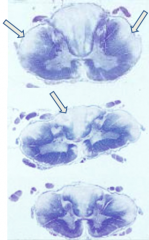 Vitamin B12 (Cobalamin) Deficiency: subacute combined degeneration of the spinal cord (anterior and lateral corticospinal tracts and posterior columns are vacuolated and demyelinated)