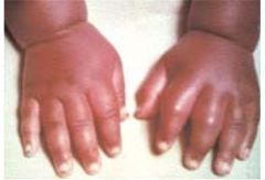 symmetric painful swelling of hands and feet
ischemic necrosis of small bones