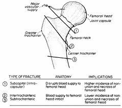 The types of hip fracture are.


1.  Femoral neck fracture.


2.  Inter-trochantric fracture.


3.  Sub-trochantric fracture.