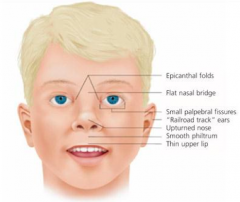 - Growth retardation
- Facial deformities: short palpebral fissure, epicanthal folds, thin upper limb, growth retardation of jaw
- Cardiac defects: atrial septal defect
- Delayed development and mental deficiency