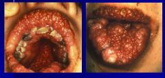 oral florid papillomatosis --> verrucous carcinoma in the mouth!!!


 


associated with smoking, irradiation, chronic inflammation


 


a/w HPV 6, 11


 


 