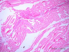 This slide from muscle in a cow's leg shows necrotic myocytes, oedema and emphysema. What is the most likely diagnosis?