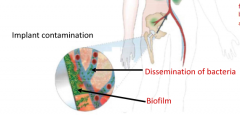 Once a patient gets infected from a hip infection, the biofilm will
constantly grow and are very problematic

Even if cleared once, it can keep growing back