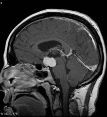 craniopharyngioma


calcification on cxr

major morbidity = panhypopituitarism, growth failure, visual loss

surgery and radiation (no chemo)