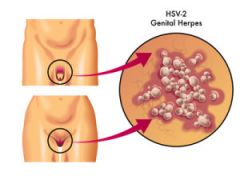 herpes genitalis ( herpes simplex virus, HSV-2)