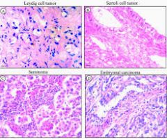 Leydig and Sertoli cell tumors