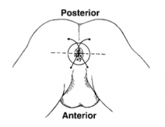 - Fistulas originating anterior to a transverse line through the anus will course STRAIGHT ahead and exit anteriorly


 


- Fistulas exiting posteriorly have a CURVED tract


 