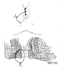 Thick suture placed through fistula tract to allow slow transection of sphincter muscle; scar tissue formed will hold the sphincter muscle in place and allow for continence after transection


 