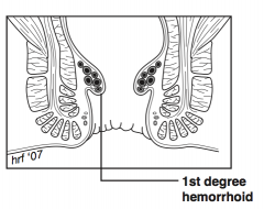 Hemorrhoid that does not prolapse


 