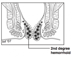 Hemorrhoid prolapses with defecation but returns on its own