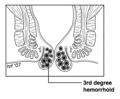 Hemorrhoid prolapses with defecation or any type of Valsalva maneuver and requires active manual reduction (eat fiber!)


 