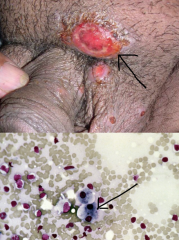 Klebsiella (Calymmatobacterium) granulomatis

cytoplasmic Donocan bodies

(bipolar staining in micrsopy)

symptoms:
painless, beefy red ulcer that bleeds readily on contact

