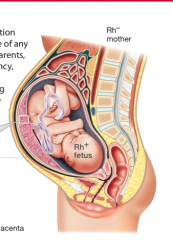 HDN is hemolytic disease of the newborn. The mother needs to be Rh- and the fetus needs to be Rh+. 