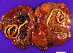 What type of placenta? 


 


30% of twin placentas are what type? 


 


All twins with this type of placenta are what? 