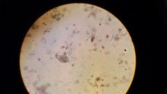 trophozoite: 15-50 microns
has a more obvious peripheral chromatin surrounding the nucleus 
has a cytoplasm: dirty, granular
  and bacteria
endosome: large and not compact 
cyst: 8 mature nuclei (sometimes 16) and 2 immature
peripheral chromatin- ...