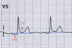 Inflammation of the pericardium produces characteristic chest pain (retrosternal, pleuritic, worse on lying flat, relieved by sitting forward), tachycardia and dyspnoea.


PR interval depressed, elevated ST segment