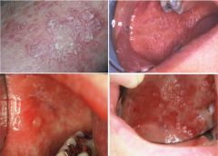 Immune System Disorders: Lichen Planus


(4 P's)
