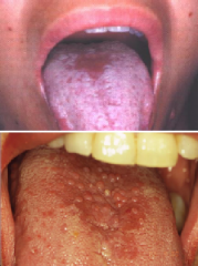 Infections: Median Rhomboid Glossitis - Candida