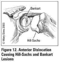 Compression fracture of posterior humeral head due to forceful impaction of an anteriorly dislocated humeral head against the glenoid rim