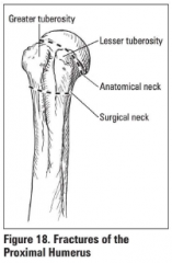 Anatomic neck fractures; disrupt blood supply to the humeral head and AVN may ensue