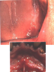 Neoplasms: Erythroplakia - "Red Patch"