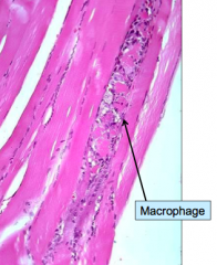Destruction of all or part of a myofiber; stimulates infiltration by macrophages