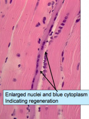 Regeneration
- Satellite cells around degenerated fiber proliferate
- Regenerating fiber has a bluish color