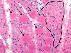 - Large groups of rounded atrophic fibers (panfascicular atrophy - dotted black line)
- Sparse scattered markedly hypertrophic fibers (arrows)
- Differs from typical pattern of neurogenic atrophy see in adults
