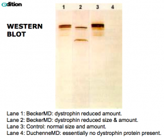 - Becker MD: dystrophin reduced in size and amount (lane 1, 2)
- Duchenne MD: essentially no dystrophin present (lane 4)